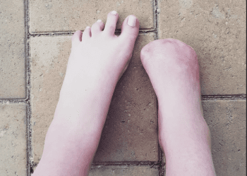 Poszła na zabieg pedicure. Lekarze musieli jej amputować pięć palców