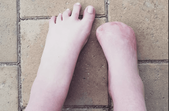 Poszła na zabieg pedicure. Lekarze musieli jej amputować pięć palców