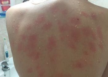 19-latka jest uczulona na wodę. Ból sprawiają jej nawet własne łzy