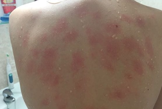 19-latka jest uczulona na wodę. Ból sprawiają jej nawet własne łzy