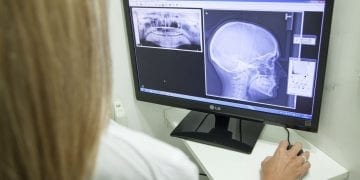 Udar mózgu to poważne zagrożenie życia. Neurolodzy wskazują objawy, które powinny wzbudzać niepokój