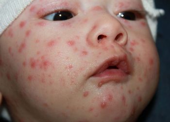 Odra w Polsce. Drastyczny wzrost liczby zachorowań!