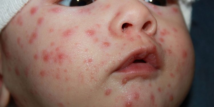 Odra w Polsce. Drastyczny wzrost liczby zachorowań!