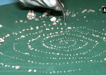 Usunęli 7-latkowi… 526 zębów. Rzadka choroba