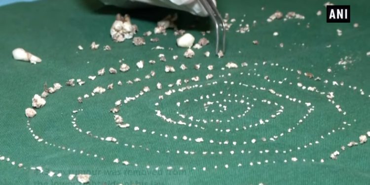 Usunęli 7-latkowi… 526 zębów. Rzadka choroba