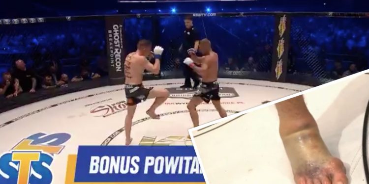 Potworna kontuzja stopy Polaka podczas KSW 50. Zdjęcie trafiło do sieci [FOTO+WIDEO]