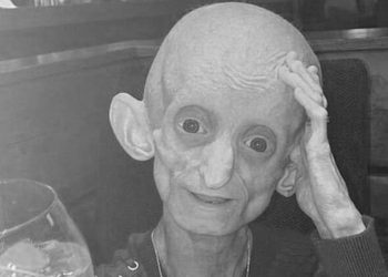 18-latka w ciele staruszki nie żyje. Cierpiała na nietypową chorobę