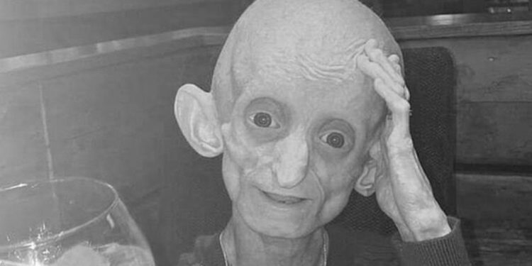 18-latka w ciele staruszki nie żyje. Cierpiała na nietypową chorobę